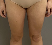 Thigh Lift After Photo by Keshav Magge, MD; Bethesda, MD - Case 47604