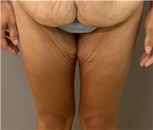 Thigh Lift Before Photo by Keshav Magge, MD; Bethesda, MD - Case 47604