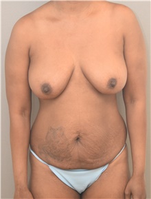 Tummy Tuck Before Photo by Keshav Magge, MD; Bethesda, MD - Case 47605