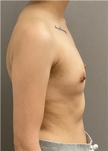 Breast Augmentation Before Photo by Keshav Magge, MD; Bethesda, MD - Case 47607