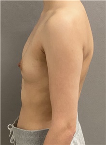 Breast Augmentation Before Photo by Keshav Magge, MD; Bethesda, MD - Case 47607