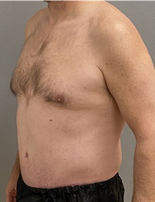 Tummy Tuck After Photo by Keshav Magge, MD; Bethesda, MD - Case 47608