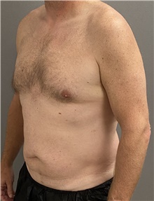 Tummy Tuck Before Photo by Keshav Magge, MD; Bethesda, MD - Case 47608