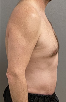Tummy Tuck After Photo by Keshav Magge, MD; Bethesda, MD - Case 47608