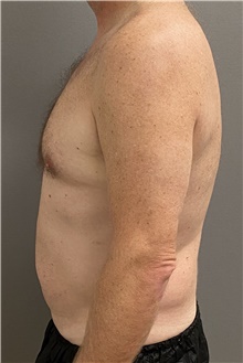 Tummy Tuck Before Photo by Keshav Magge, MD; Bethesda, MD - Case 47608