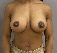 Breast Augmentation After Photo by Keshav Magge, MD; Bethesda, MD - Case 47609