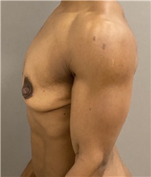 Breast Augmentation Before Photo by Keshav Magge, MD; Bethesda, MD - Case 47609