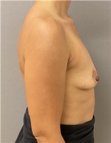 Breast Augmentation Before Photo by Keshav Magge, MD; Bethesda, MD - Case 47610