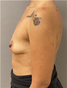 Breast Augmentation Before Photo by Keshav Magge, MD; Bethesda, MD - Case 47610