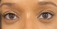 Eyelid Surgery After Photo by Keshav Magge, MD; Bethesda, MD - Case 47611