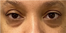 Eyelid Surgery Before Photo by Keshav Magge, MD; Bethesda, MD - Case 47611