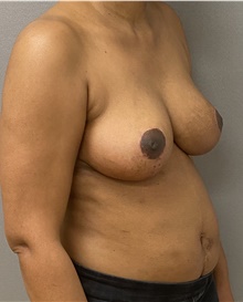 Breast Reduction After Photo by Keshav Magge, MD; Bethesda, MD - Case 47612