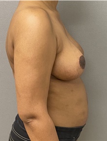 Breast Reduction After Photo by Keshav Magge, MD; Bethesda, MD - Case 47612