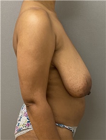 Breast Reduction Before Photo by Keshav Magge, MD; Bethesda, MD - Case 47612