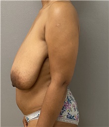 Breast Reduction Before Photo by Keshav Magge, MD; Bethesda, MD - Case 47612