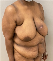 Tummy Tuck Before Photo by Keshav Magge, MD; Bethesda, MD - Case 47613