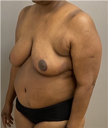 Tummy Tuck After Photo by Keshav Magge, MD; Bethesda, MD - Case 47613