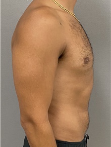 Male Breast Reduction After Photo by Keshav Magge, MD; Bethesda, MD - Case 47615
