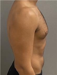 Male Breast Reduction Before Photo by Keshav Magge, MD; Bethesda, MD - Case 47615