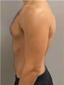 Male Breast Reduction Before Photo by Keshav Magge, MD; Bethesda, MD - Case 47615