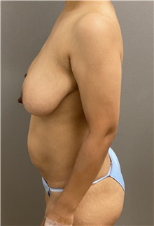 Breast Reduction Before Photo by Keshav Magge, MD; Bethesda, MD - Case 47616