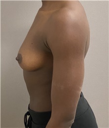 Breast Augmentation Before Photo by Keshav Magge, MD; Bethesda, MD - Case 47619