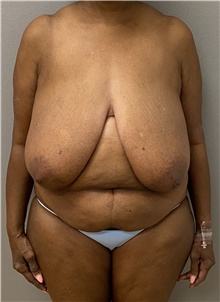 Breast Reduction Before Photo by Keshav Magge, MD; Bethesda, MD - Case 47620