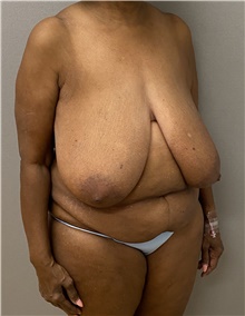 Breast Reduction Before Photo by Keshav Magge, MD; Bethesda, MD - Case 47620