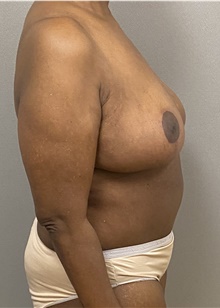 Breast Reduction After Photo by Keshav Magge, MD; Bethesda, MD - Case 47620