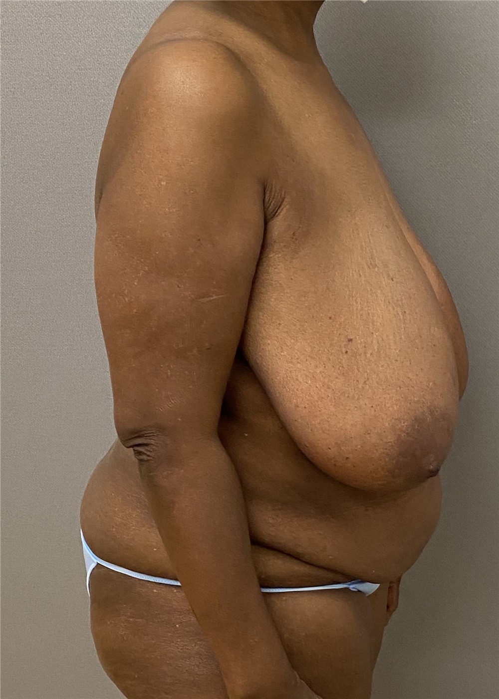 Breast Reduction Before and After Photos by Keshav Magge, MD