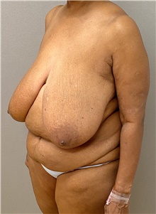 Tummy Tuck Before Photo by Keshav Magge, MD; Bethesda, MD - Case 47621