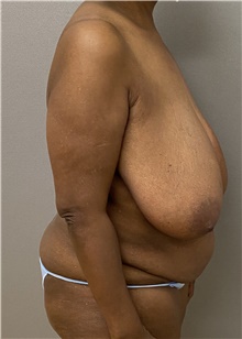 Tummy Tuck Before Photo by Keshav Magge, MD; Bethesda, MD - Case 47621