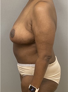 Tummy Tuck After Photo by Keshav Magge, MD; Bethesda, MD - Case 47621