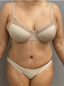 Tummy Tuck After Photo by Keshav Magge, MD; Bethesda, MD - Case 47775
