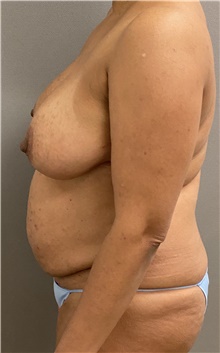 Tummy Tuck Before Photo by Keshav Magge, MD; Bethesda, MD - Case 47775