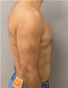 Liposuction After Photo by Keshav Magge, MD; Bethesda, MD - Case 47799