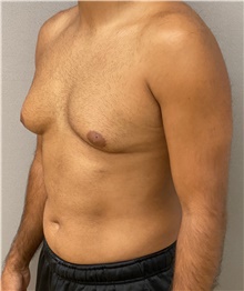 Liposuction Before Photo by Keshav Magge, MD; Bethesda, MD - Case 47799