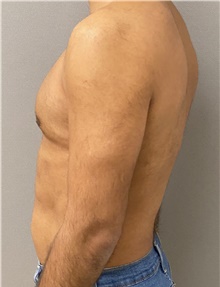 Liposuction After Photo by Keshav Magge, MD; Bethesda, MD - Case 47799