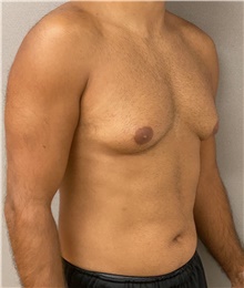 Male Breast Reduction Before Photo by Keshav Magge, MD; Bethesda, MD - Case 47802