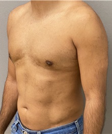 Male Breast Reduction After Photo by Keshav Magge, MD; Bethesda, MD - Case 47802