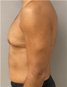 Male Breast Reduction Before Photo by Keshav Magge, MD; Bethesda, MD - Case 47802