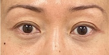 Eyelid Surgery After Photo by Keshav Magge, MD; Bethesda, MD - Case 47803