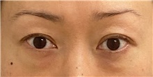Eyelid Surgery Before Photo by Keshav Magge, MD; Bethesda, MD - Case 47803