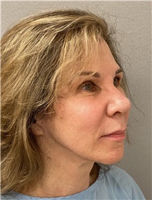 Facelift Before Photo by Keshav Magge, MD; Bethesda, MD - Case 47804