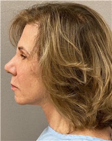 Facelift Before Photo by Keshav Magge, MD; Bethesda, MD - Case 47804