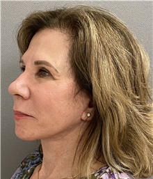 Neck Lift After Photo by Keshav Magge, MD; Bethesda, MD - Case 47806