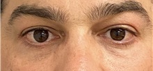 Eyelid Surgery After Photo by Keshav Magge, MD; Bethesda, MD - Case 47807