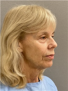 Facelift Before Photo by Keshav Magge, MD; Bethesda, MD - Case 47816