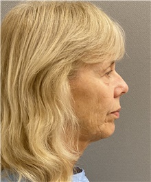 Facelift Before Photo by Keshav Magge, MD; Bethesda, MD - Case 47816