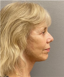 Neck Lift After Photo by Keshav Magge, MD; Bethesda, MD - Case 47817